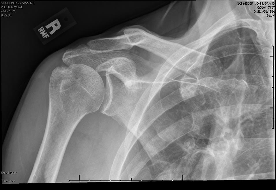 collar-bone